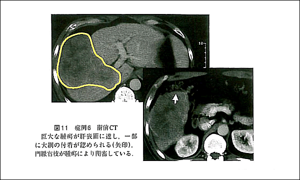 学術誌「肝胆膵」2007年11月号に掲載されたケース