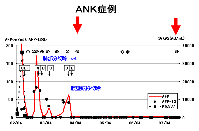 ＡＮＫ症例